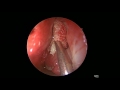 endoscopic dcr case 2 dr. satish jain www.skullbase360.in .