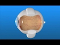 Scleral Buckle