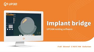 How to use UPCAM for implant bridge?