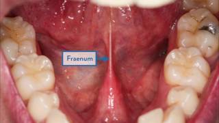 How To Check Your Mouth- A Guide To Spotting Mouth Cancer