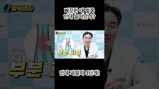 삐끗한 내 발목 인대 늘어났나?🤔 인대 파열의 3단계!