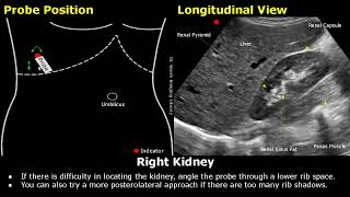 Kidney Ultrasound Probe Positioning | Transducer Placement \u0026 Scanning | Abdominal USG | Sonography