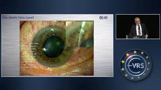 Treatment of Post-traumatic Hypotony Related to Cyclodialysis Cleft: Our Experience in Two Cases