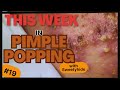 This Week in PIMPLE POPPING #19