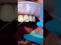 no prep ceramic veneer repair part i veneers repairs biomimeticdentistry