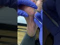 warding off foot woes watch how an aussie podiatrist tackles thick callus removal.