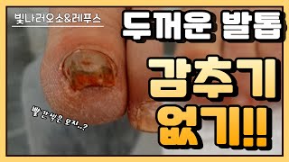 (ENG SUB)두꺼운 발톱 젤네일로 감추기 없기요!!/빛나러오소  발톱무좀 스케일링