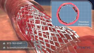 3D Medical Animation of Coronary Stent Procedure