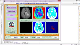 Brain Tumor Detection Using Matlab !! IEEE Based Project