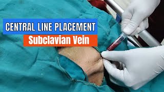 Central Line placement: Subclavian Vein Approach