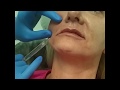 Ageless in the Triad Med Spa, Kernersville, NC: Injectable Fillers Enhance Your Look Without Surgery