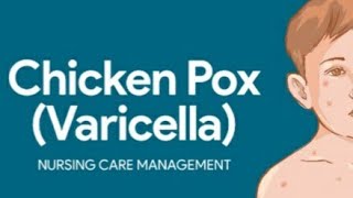 Chicken pox (පැපොල)