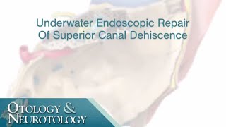 Underwater Endoscopic Repair of Superior Canal Dehiscence