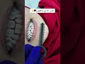 روعة اللون الأسود في تقويم الأسنان explore dr_abdullah_sultan_dentist اكسبلور اسنان