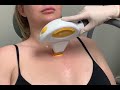 IPL Laser Treatment to Chest for Sun Spots in Weston FL