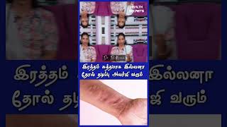 இரத்தம் சுத்தமாக இல்லனா அலர்ஜி வரும் | தோல் தடிப்பு ஆபத்தா | CAUSES AND SYMPTOMS OF URTICARIA