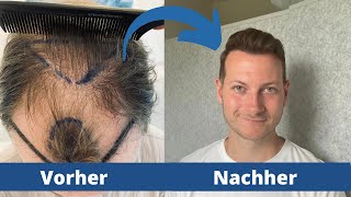 Vorher Nachher Verlauf nach der Haartransplantation bei Elithair