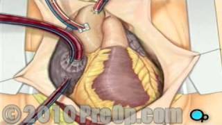 Coronary Artery Bypass Graft (CABG) Surgery PreOp® Patient Education
