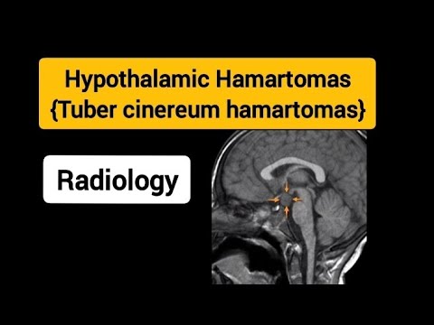 Hypothalamic Hamartomas Radiology Basic Radiology Youtube