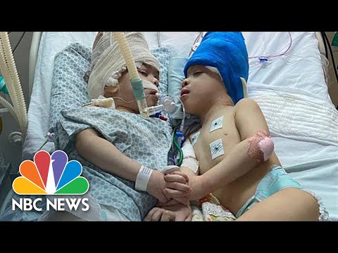 Do conjoined twins have two hearts?