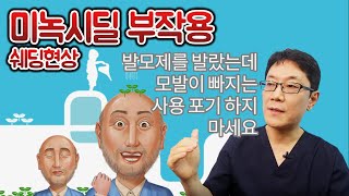 미녹시딜부작용 쉐딩현상 발모제 탈모치료약 계속 사용해야 할까요?