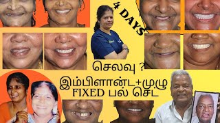 இந்தியாவில் முழு Fixed  பல் செட் + இம்பிளான்ட் செலவு எவ்வளவு ! செயல் முறை விளக்கங்களுடன்!