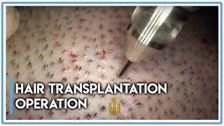 Details of Hair Transplantation Operation ( ULTRA ZOOM )