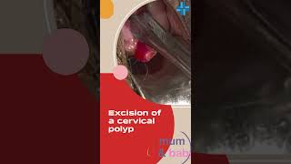 Cervical polypectomy by Dr Mohammed Musthaq VOG. 👌👍#vog #polyps #bleeding 💯👍