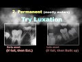 paper review etiology and treatment of tooth ankylosis｜【chris chang ortho】cc577