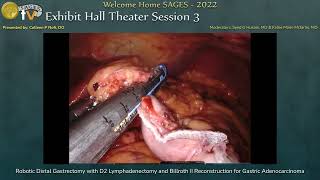 Robotic Distal Gastrectomy with D2 Lymphadenectomy and Billroth II Reconstruction for Gastric Ad...