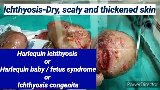 A case of Harlequin ichthyosis in newborn | Pediatrics