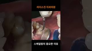 [리더스진 치과의원] 스케일링 치석 ASMRㅣ6개월 정기 스케일링 받지 않으면 .. 치아가 다 빠집니다.