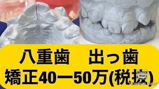 14)八重歯　出っ歯　白いワイヤー矯正　安い費用値段　埼玉大宮鈴木歯科医院