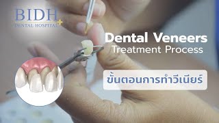 Dental Veneers Treatment Process ขั้นตอนการทำวีเนียร์ | CosmeticBangkokDentist.com