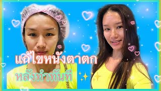 แก้ไขหนังตาตก เปิดหัวตา คุณหมอหลิน inz clinic