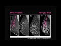 Check Your Chart - Find Out My Breast Density Day 2023