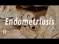 What Is Endometriosis?