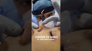 CIRUGÍA DE NARIZ ESTÉTICA Y FUNCIONAL FEMENINA.  RINOPLASTIA