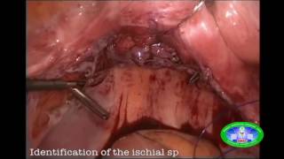 Laparoscopic Uterosacral Vaginal Vualt Suspension