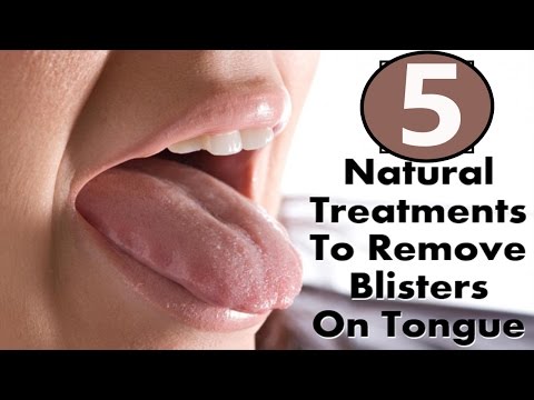 5 Home Remedies to Get Rid of Tongue Blisters Fast. 5 Home Remedies to Get Rid of Tongue Blisters Fast.