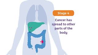 Stages of cancer