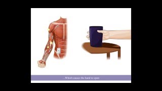 Basic FES Hand Grasp for a Cervical Level Spinal Cord Injury