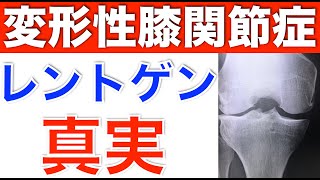 【レントゲンに写らない膝痛】膝の痛みの疑問解決