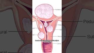 Uterine Polyp vs Fibroids