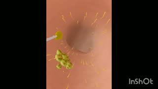 ASMR Popping pustules behind the pinna due to dirty glasses | Earwax animation