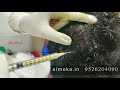 nanofat for hair restoration nano prp – the latest in regenerative medicine