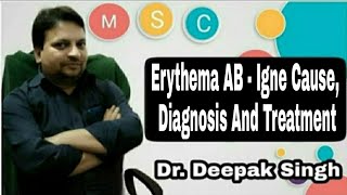 Erythema AB - Igne Cause, Diagnosis And Treat. # Heat Exposure In hand And Feet # Deepak PD. Singh