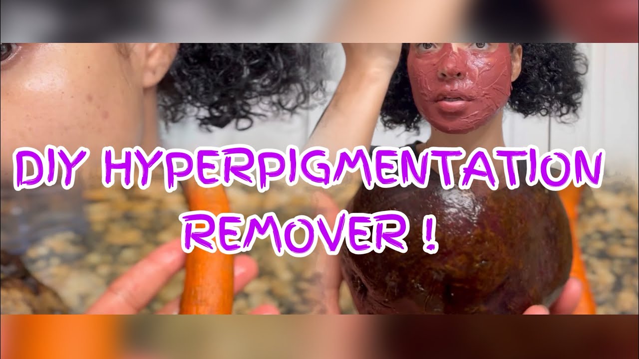 Diy Hyperpigmentation Remover Youtube