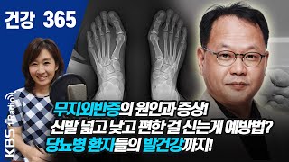 [건강365]무지외반증의 원인과 증상! 신발 넓고 낮고 편한 걸 신는게 예방법? 당뇨병 환자들의 발건강까지! #정진화 #무지외반증  #건강365 200720