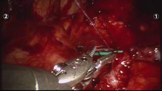 Robotic Left Pyeloplasty Surgery | Uro Care Chennai
